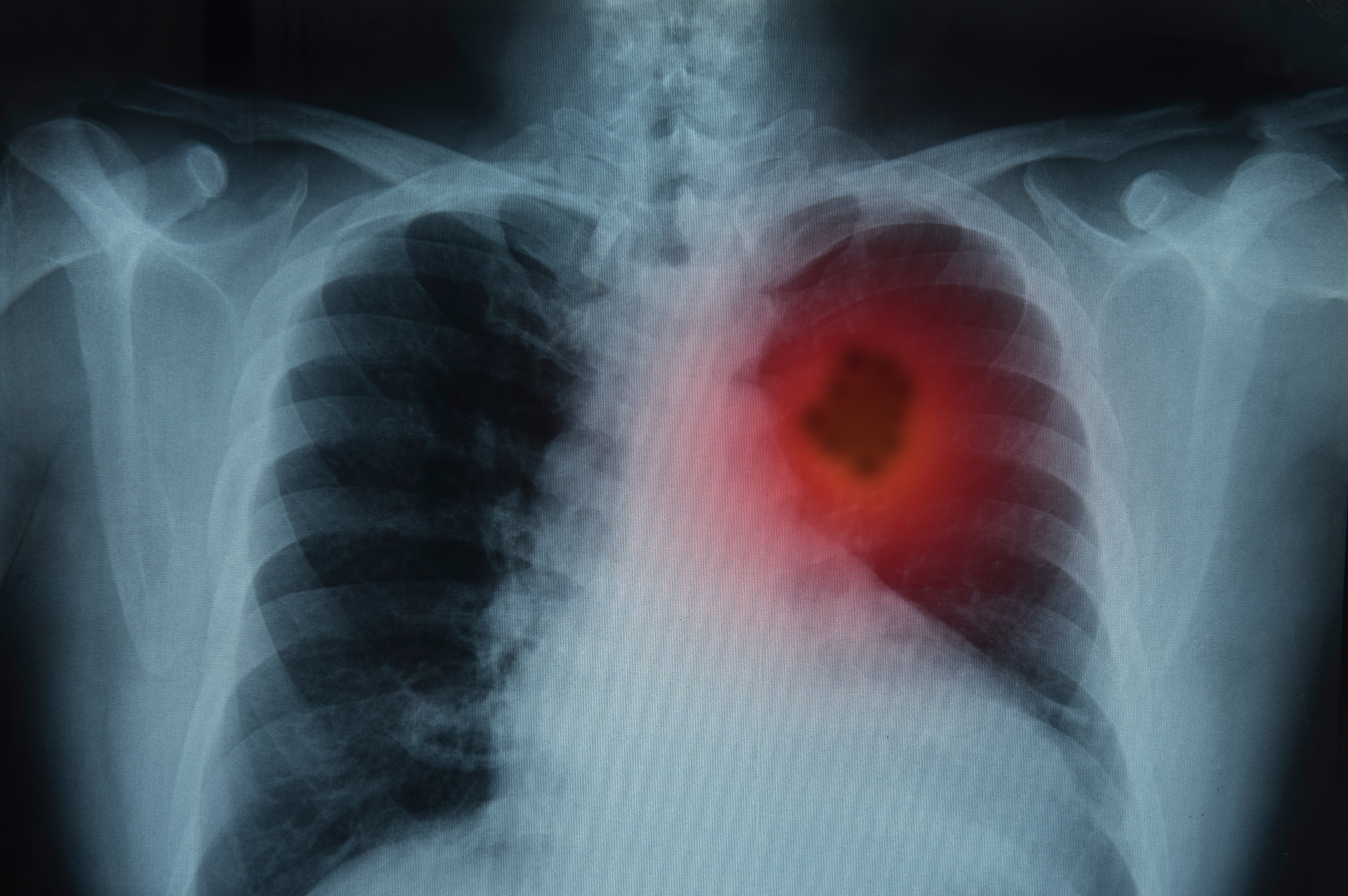 x-ray of lungs showing cancer